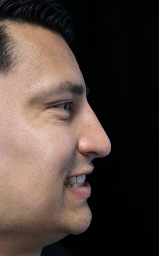 Beverly Hills Rhinoplasty Before & After Gallery - Patient 341503 - Image 12 Dr. Deepak Raj Dugar