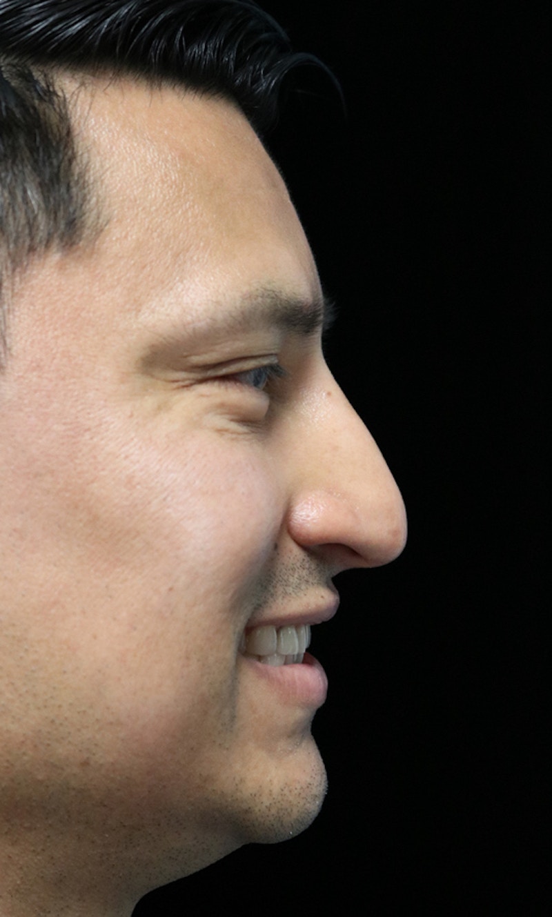 Beverly Hills Rhinoplasty Before & After Gallery - Patient 341503 - Image 11 Dr. Deepak Raj Dugar