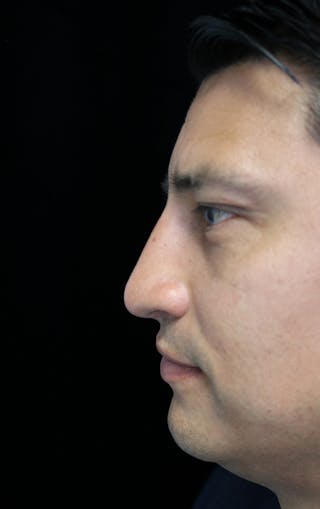 Beverly Hills Rhinoplasty Before & After Gallery - Patient 341503 - Image 14 Dr. Deepak Raj Dugar