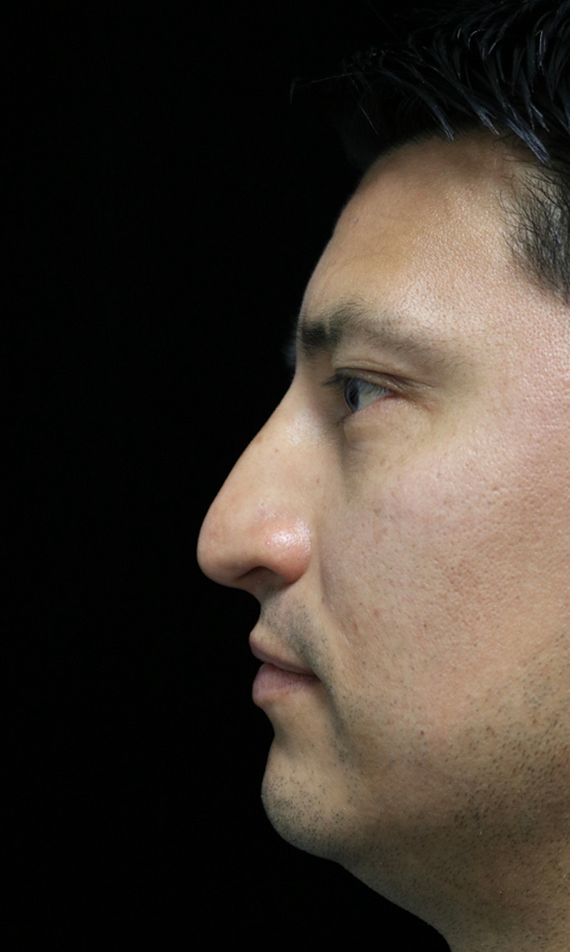 Beverly Hills Rhinoplasty Before & After Gallery - Patient 341503 - Image 13 Dr. Deepak Raj Dugar