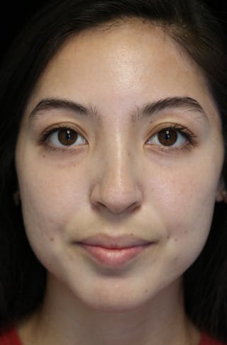 Beverly Hills Rhinoplasty Before & After Gallery - Patient 205478 - Image 4 Dr. Deepak Raj Dugar
