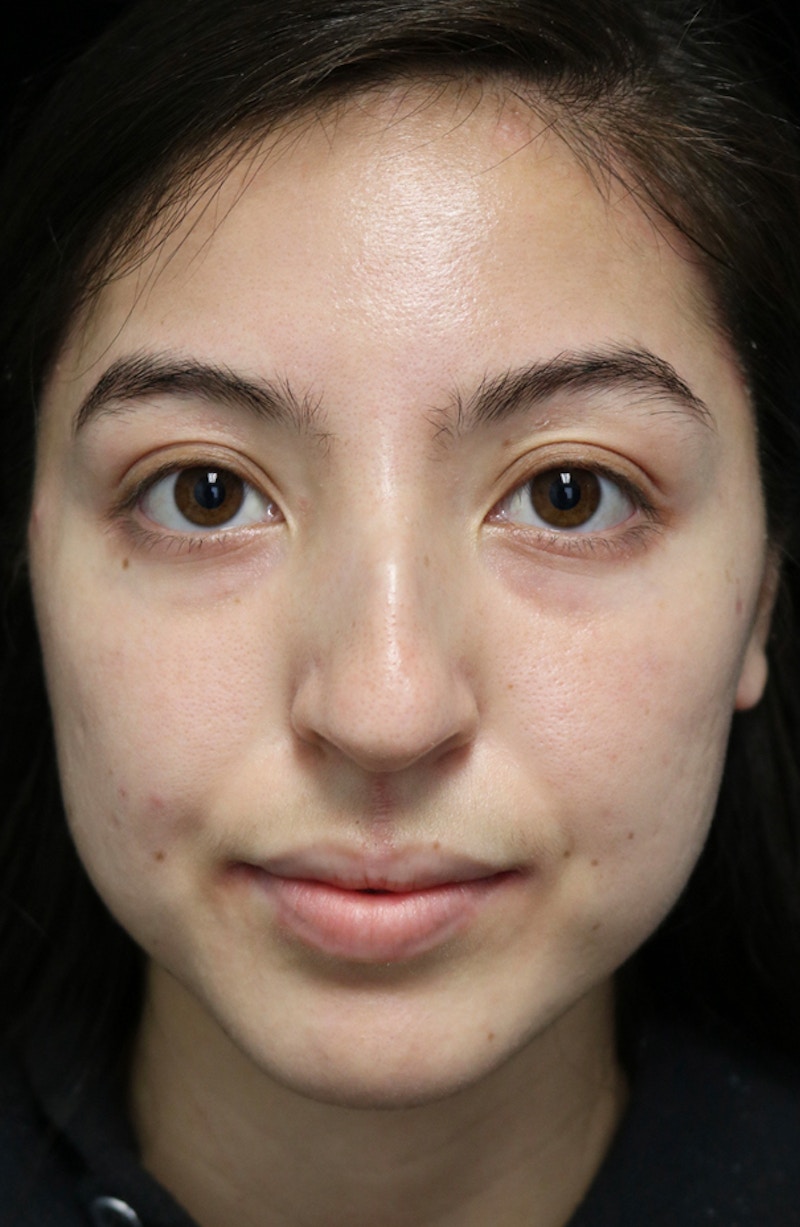 Beverly Hills Rhinoplasty Before & After Gallery - Patient 205478 - Image 3 Dr. Deepak Raj Dugar