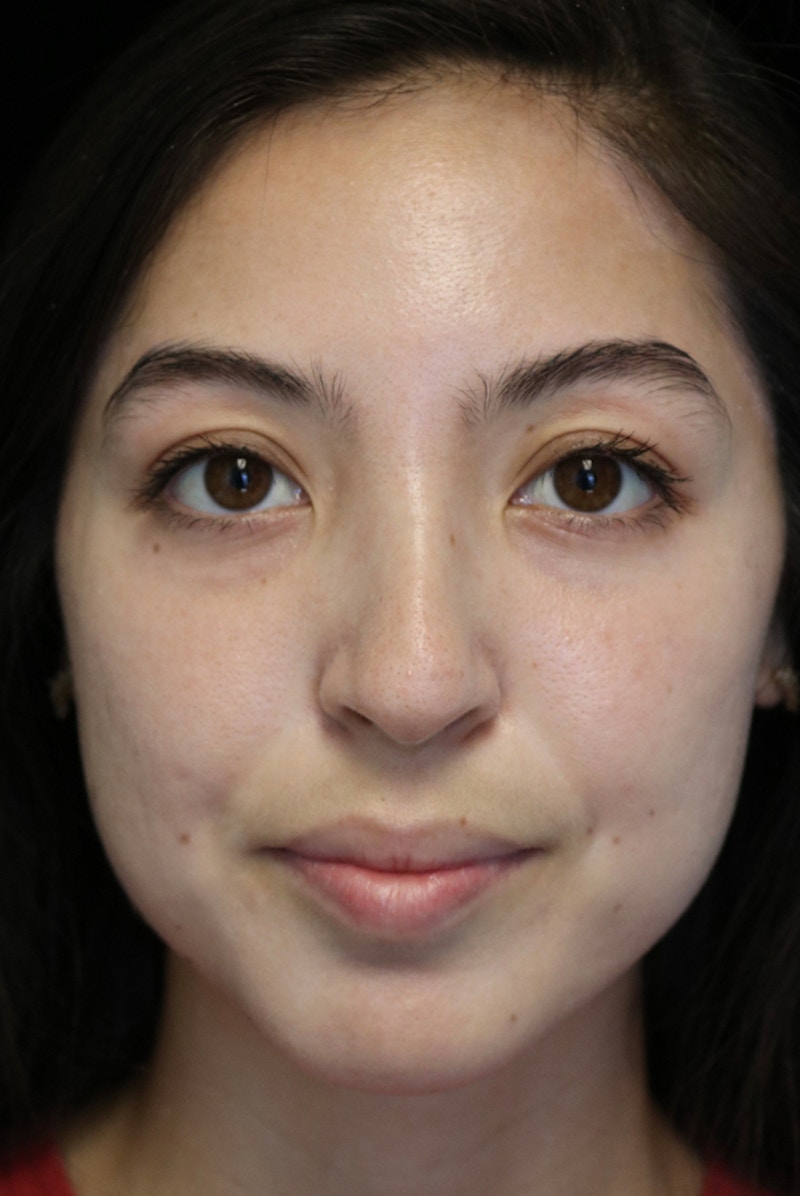 Beverly Hills Rhinoplasty Before & After Gallery - Patient 205478 - Image 6 Dr. Deepak Raj Dugar