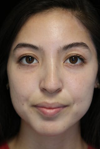 Beverly Hills Rhinoplasty Before & After Gallery - Patient 205478 - Image 6 Dr. Deepak Raj Dugar