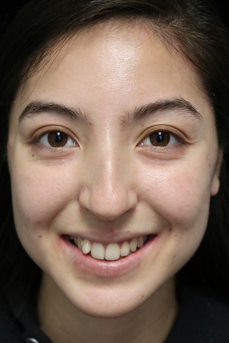 Beverly Hills Rhinoplasty Before & After Gallery - Patient 205478 - Image 5 Dr. Deepak Raj Dugar