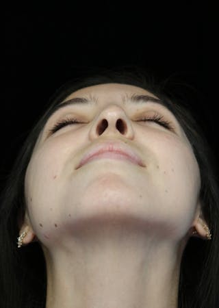 Beverly Hills Rhinoplasty Before & After Gallery - Patient 205478 - Image 8 Dr. Deepak Raj Dugar