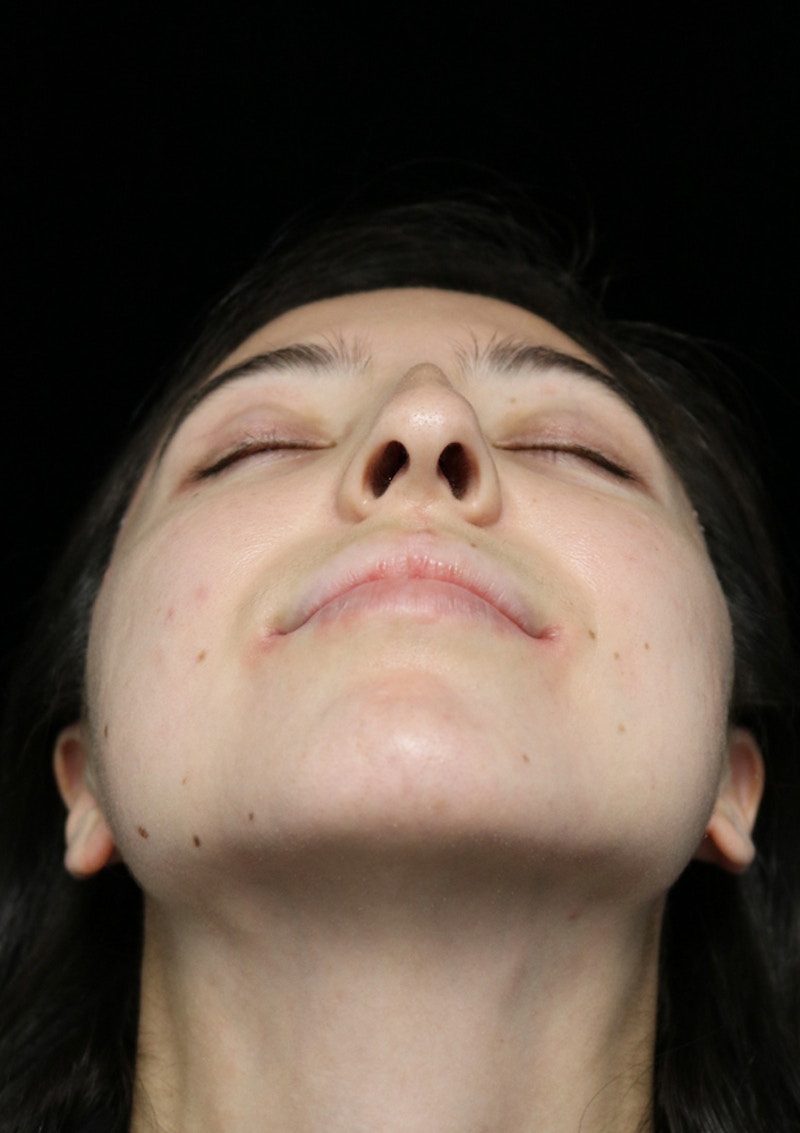 Beverly Hills Rhinoplasty Before & After Gallery - Patient 205478 - Image 7 Dr. Deepak Raj Dugar