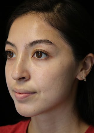 Beverly Hills Rhinoplasty Before & After Gallery - Patient 205478 - Image 10 Dr. Deepak Raj Dugar