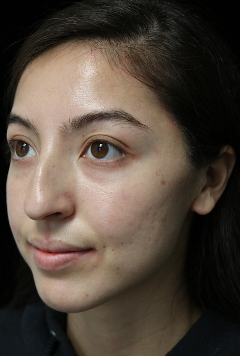 Beverly Hills Rhinoplasty Before & After Gallery - Patient 205478 - Image 9 Dr. Deepak Raj Dugar