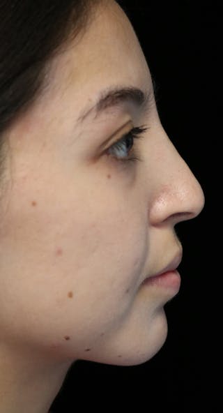 Beverly Hills Rhinoplasty Before & After Gallery - Patient 205478 - Image 2 Dr. Deepak Raj Dugar