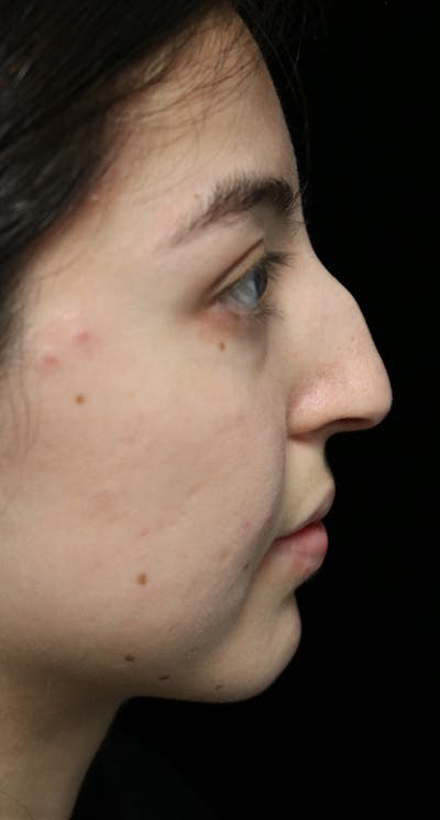 Beverly Hills Rhinoplasty Before & After Gallery - Patient 205478 - Image 1 Dr. Deepak Raj Dugar