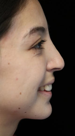 Beverly Hills Rhinoplasty Before & After Gallery - Patient 205478 - Image 12 Dr. Deepak Raj Dugar