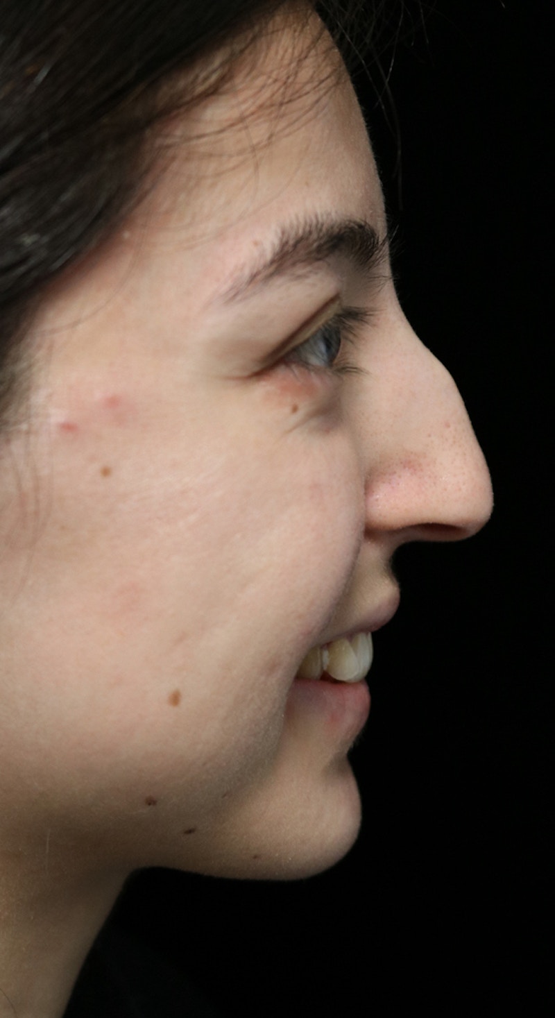 Beverly Hills Rhinoplasty Before & After Gallery - Patient 205478 - Image 11 Dr. Deepak Raj Dugar