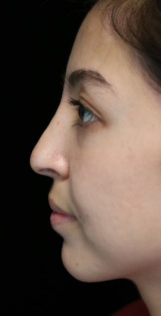 Beverly Hills Rhinoplasty Before & After Gallery - Patient 205478 - Image 14 Dr. Deepak Raj Dugar