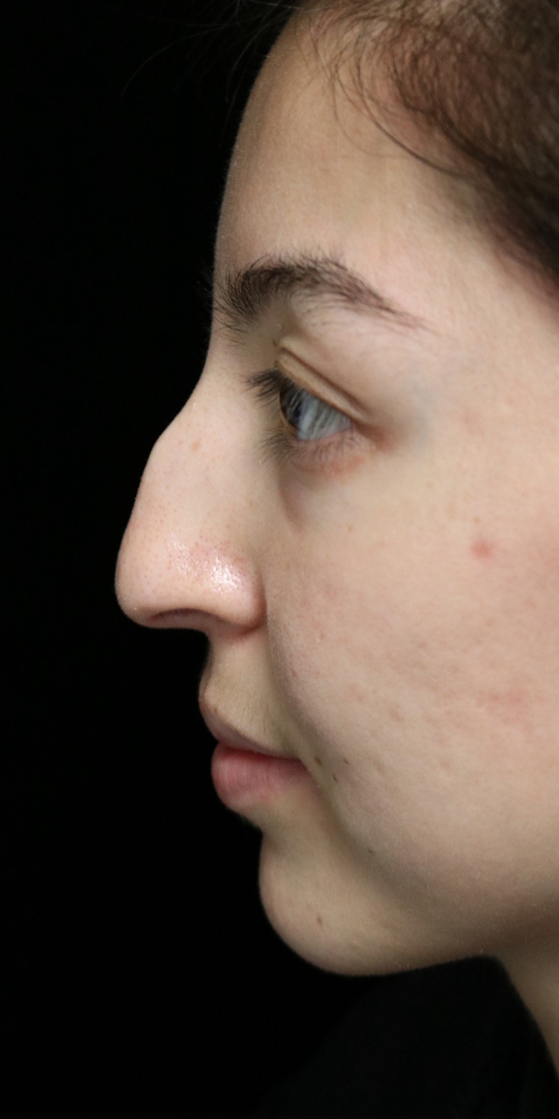 Beverly Hills Rhinoplasty Before & After Gallery - Patient 205478 - Image 13 Dr. Deepak Raj Dugar