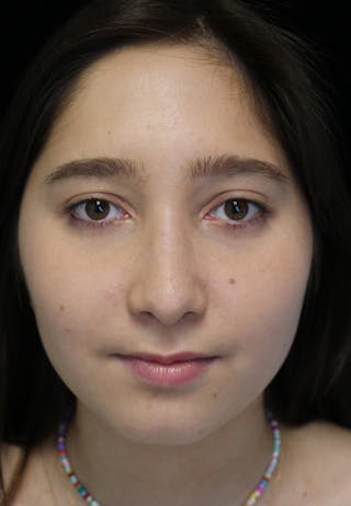 Beverly Hills Rhinoplasty Before & After Gallery - Patient 262423 - Image 4 Dr. Deepak Raj Dugar