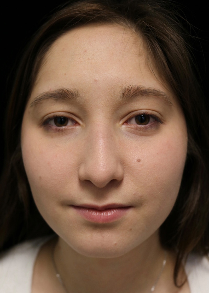Beverly Hills Rhinoplasty Before & After Gallery - Patient 262423 - Image 3 Dr. Deepak Raj Dugar