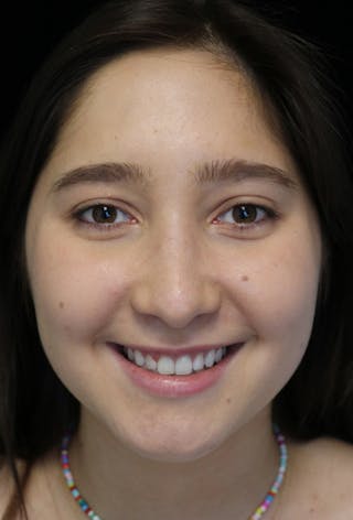 Beverly Hills Rhinoplasty Before & After Gallery - Patient 262423 - Image 6 Dr. Deepak Raj Dugar