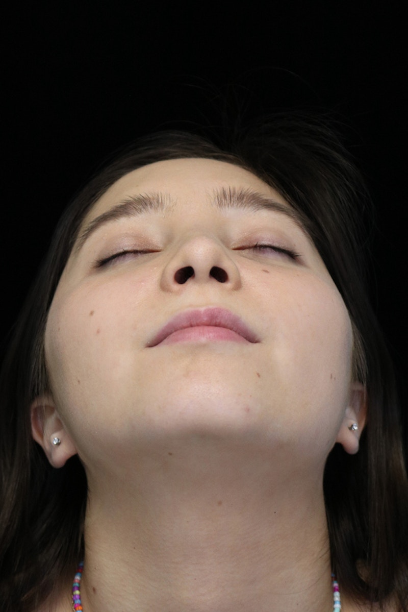 Beverly Hills Rhinoplasty Before & After Gallery - Patient 262423 - Image 8 Dr. Deepak Raj Dugar