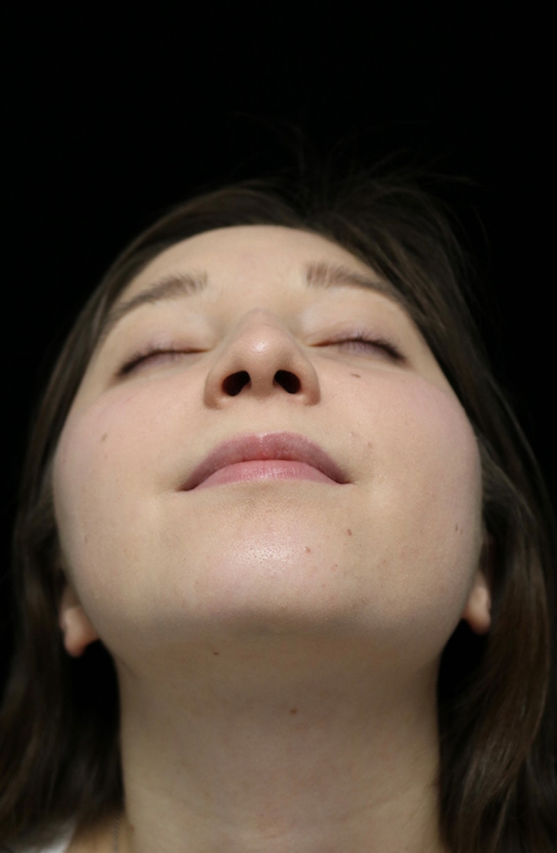 Beverly Hills Rhinoplasty Before & After Gallery - Patient 262423 - Image 7 Dr. Deepak Raj Dugar