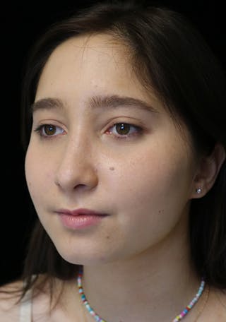 Beverly Hills Rhinoplasty Before & After Gallery - Patient 262423 - Image 10 Dr. Deepak Raj Dugar