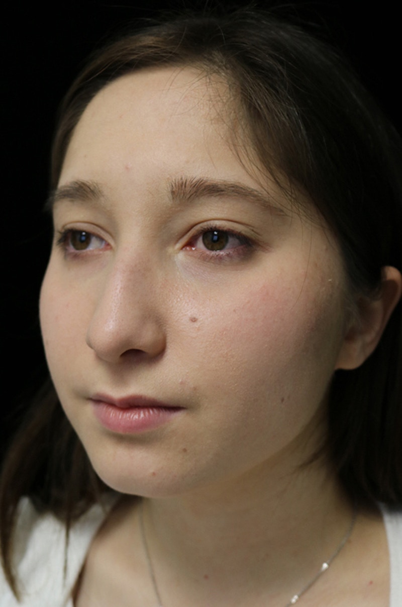 Beverly Hills Rhinoplasty Before & After Gallery - Patient 262423 - Image 9 Dr. Deepak Raj Dugar