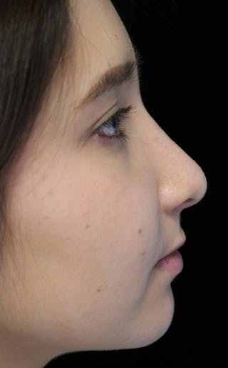 Beverly Hills Rhinoplasty Before & After Gallery - Patient 262423 - Image 2 Dr. Deepak Raj Dugar