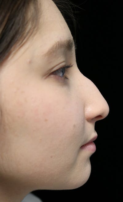 Beverly Hills Rhinoplasty Before & After Gallery - Patient 262423 - Image 1 Dr. Deepak Raj Dugar