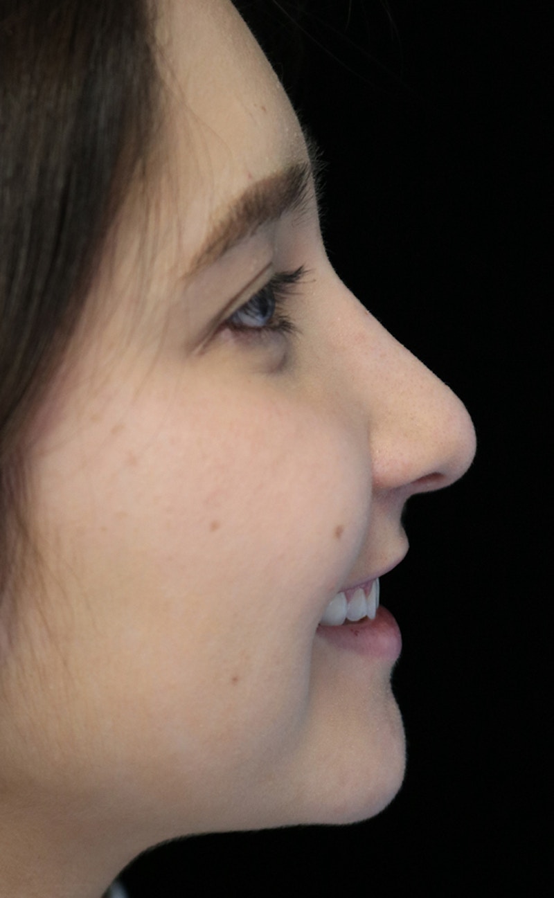Beverly Hills Rhinoplasty Before & After Gallery - Patient 262423 - Image 12 Dr. Deepak Raj Dugar