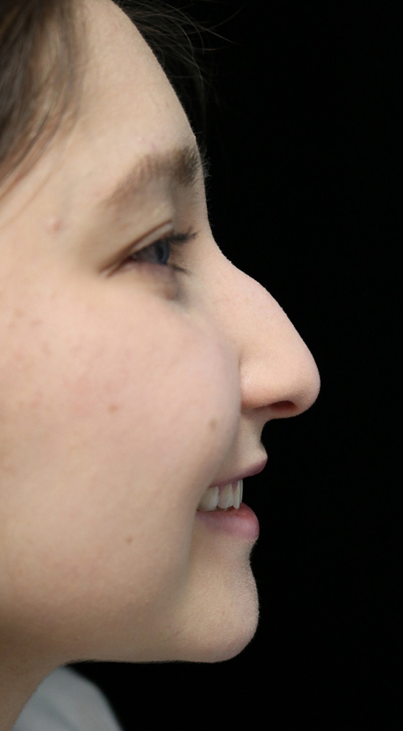 Beverly Hills Rhinoplasty Before & After Gallery - Patient 262423 - Image 11 Dr. Deepak Raj Dugar