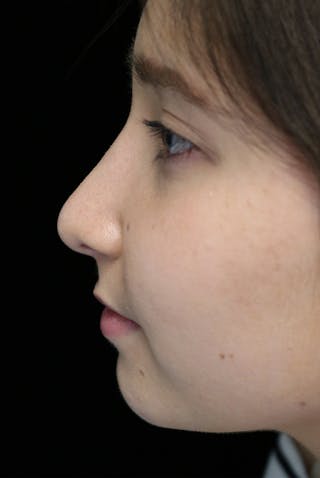 Beverly Hills Rhinoplasty Before & After Gallery - Patient 262423 - Image 14 Dr. Deepak Raj Dugar