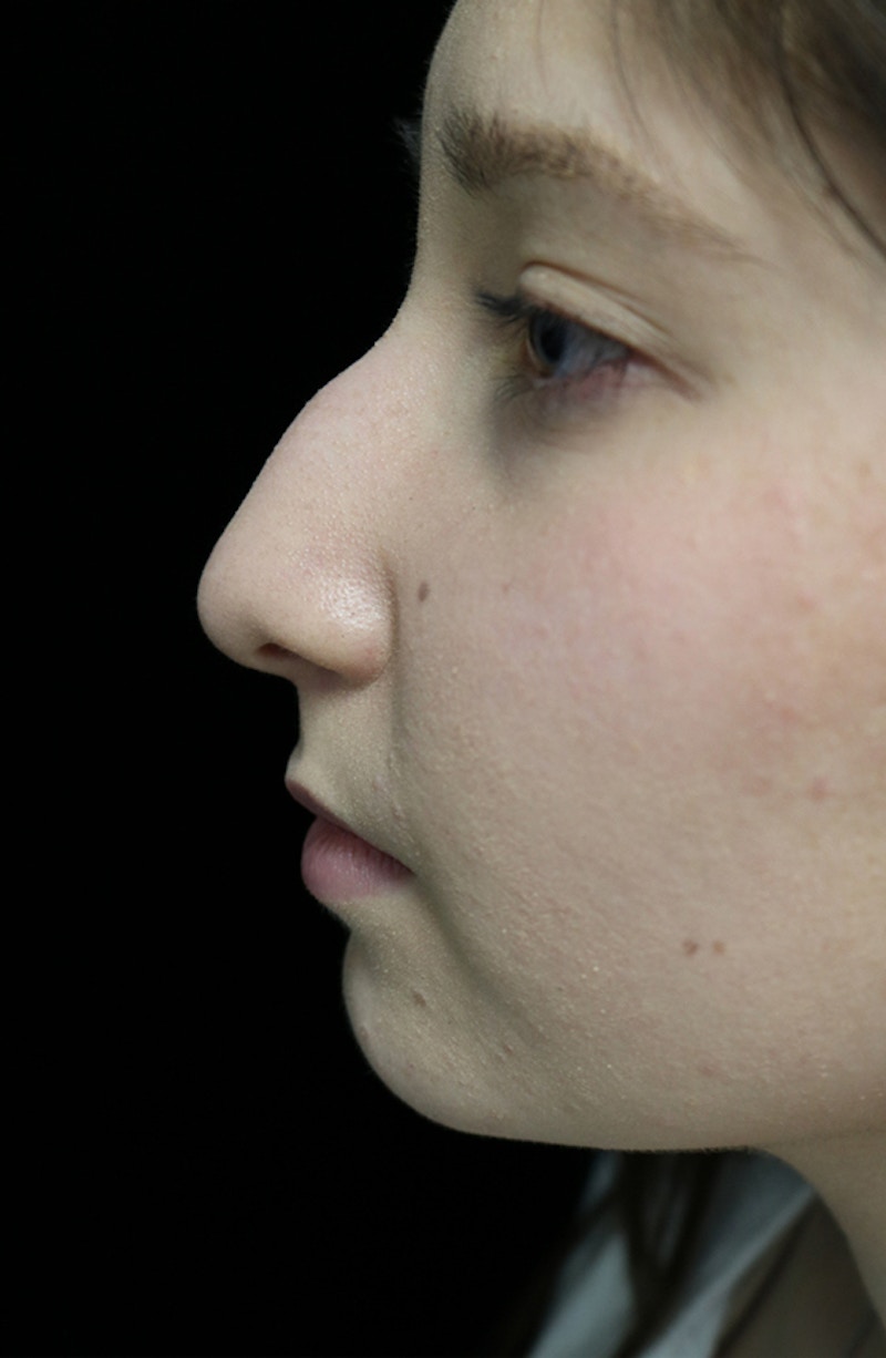 Beverly Hills Rhinoplasty Before & After Gallery - Patient 262423 - Image 13 Dr. Deepak Raj Dugar