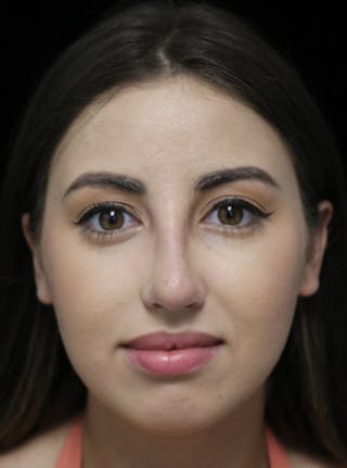 Beverly Hills Rhinoplasty Before & After Gallery - Patient 371573 - Image 4 Dr. Deepak Raj Dugar
