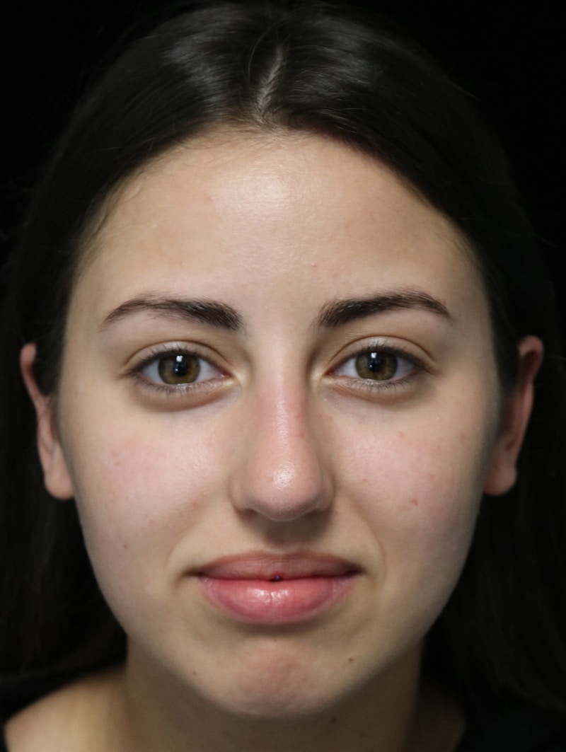 Beverly Hills Rhinoplasty Before & After Gallery - Patient 371573 - Image 3 Dr. Deepak Raj Dugar