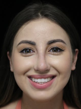 Beverly Hills Rhinoplasty Before & After Gallery - Patient 371573 - Image 6 Dr. Deepak Raj Dugar