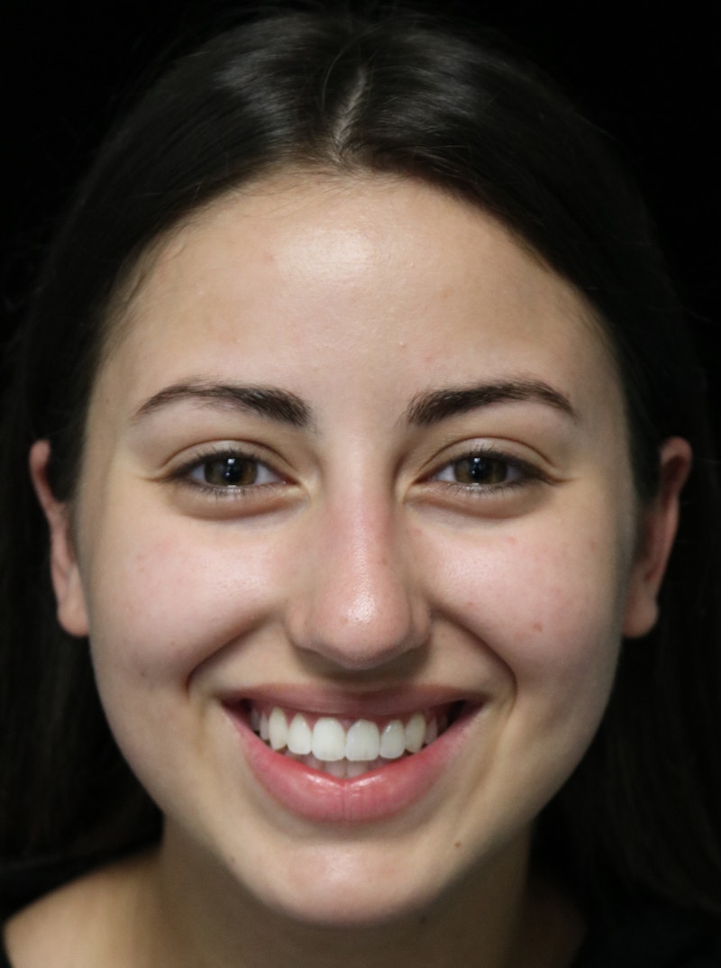 Beverly Hills Rhinoplasty Before & After Gallery - Patient 371573 - Image 5 Dr. Deepak Raj Dugar