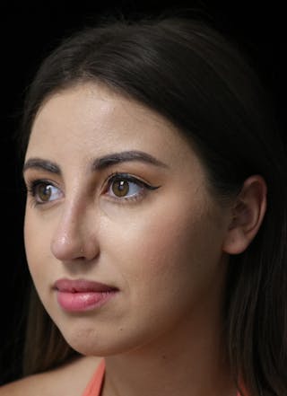 Beverly Hills Rhinoplasty Before & After Gallery - Patient 371573 - Image 8 Dr. Deepak Raj Dugar