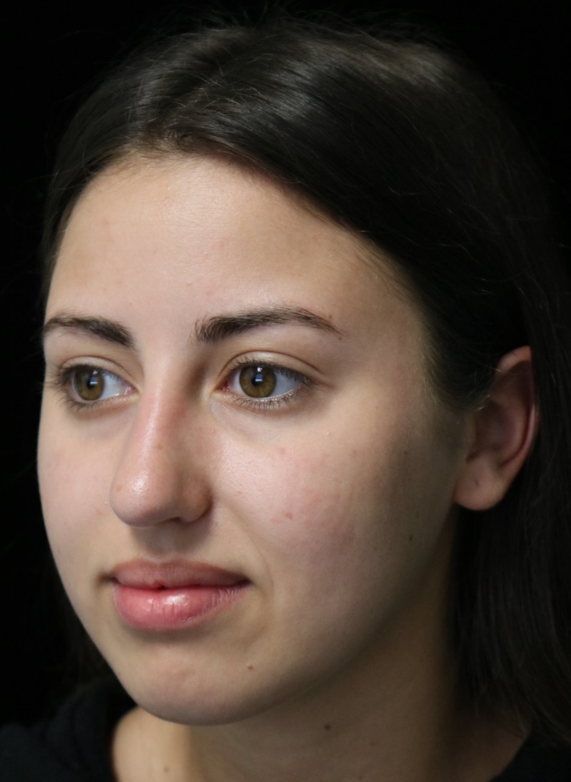Beverly Hills Rhinoplasty Before & After Gallery - Patient 371573 - Image 7 Dr. Deepak Raj Dugar