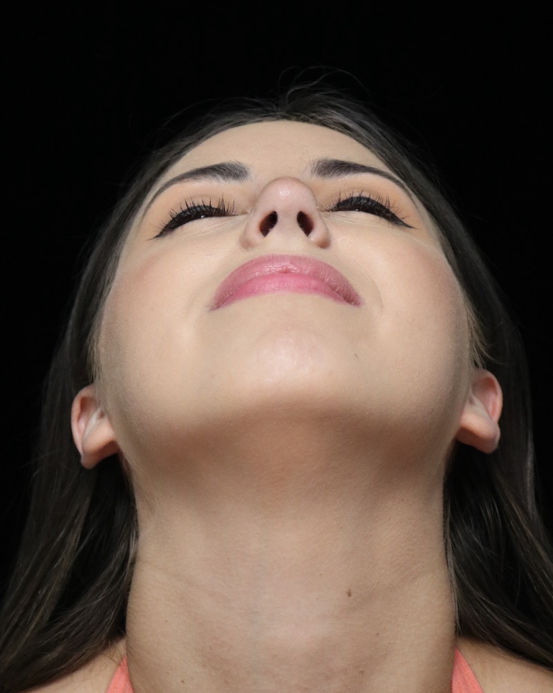 Beverly Hills Rhinoplasty Before & After Gallery - Patient 371573 - Image 10 Dr. Deepak Raj Dugar