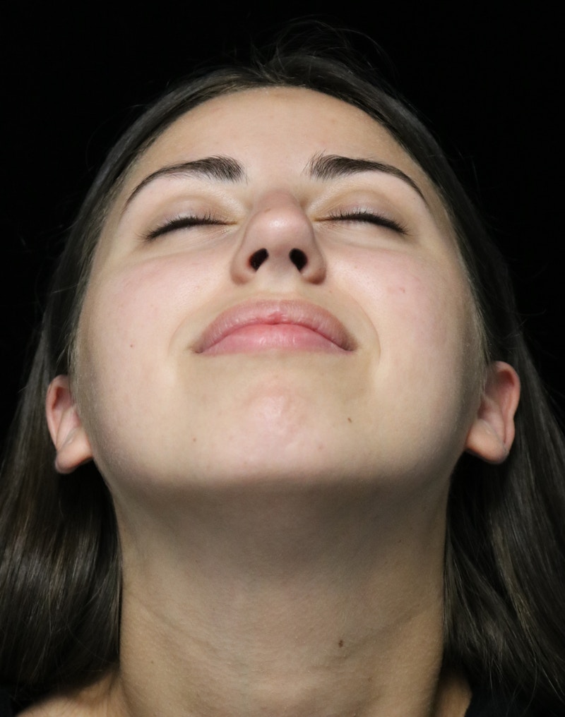 Beverly Hills Rhinoplasty Before & After Gallery - Patient 371573 - Image 9 Dr. Deepak Raj Dugar