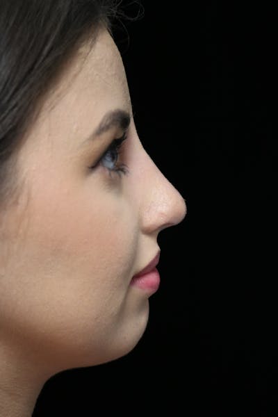Beverly Hills Rhinoplasty Before & After Gallery - Patient 371573 - Image 2 Dr. Deepak Raj Dugar