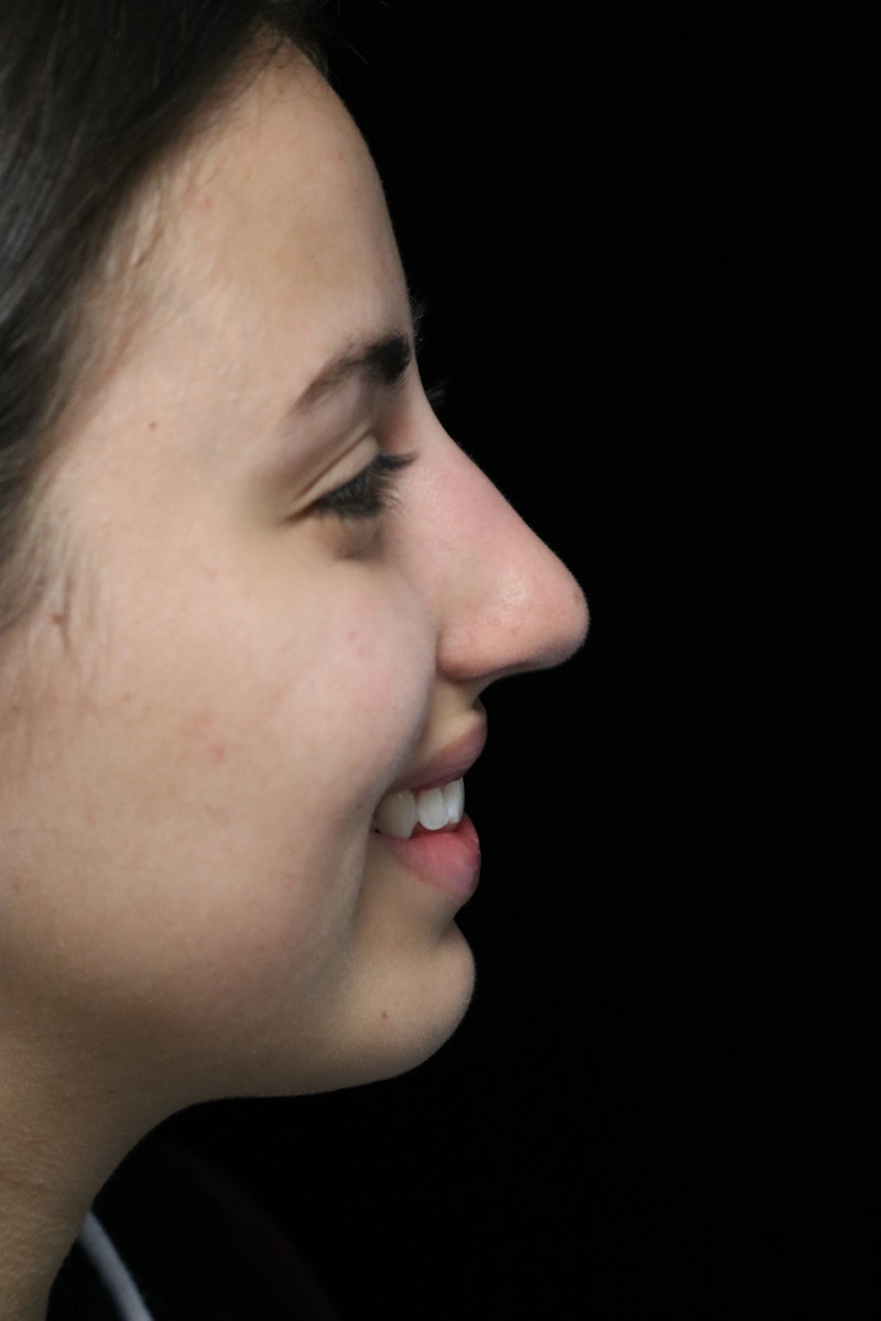 Beverly Hills Rhinoplasty Before & After Gallery - Patient 371573 - Image 11 Dr. Deepak Raj Dugar