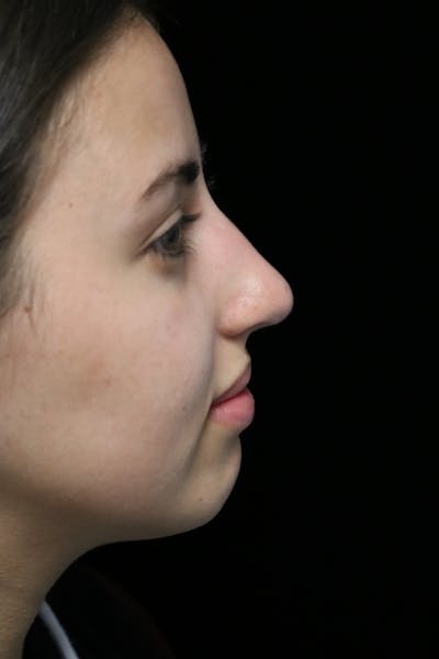 Beverly Hills Rhinoplasty Before & After Gallery - Patient 371573 - Image 1 Dr. Deepak Raj Dugar