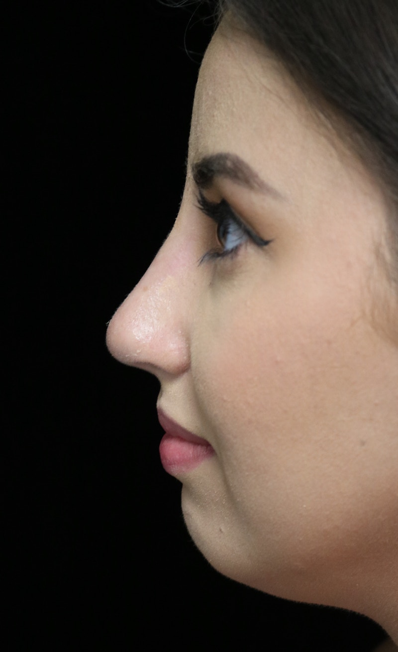 Beverly Hills Rhinoplasty Before & After Gallery - Patient 371573 - Image 14 Dr. Deepak Raj Dugar