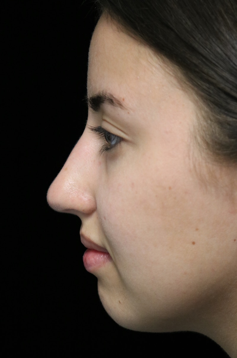 Beverly Hills Rhinoplasty Before & After Gallery - Patient 371573 - Image 13 Dr. Deepak Raj Dugar