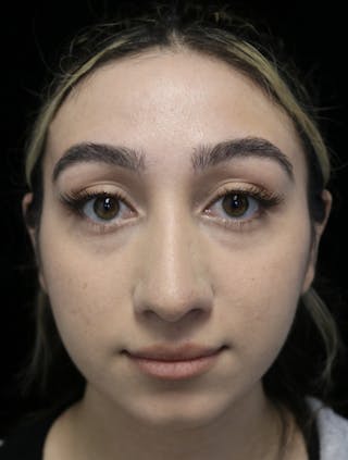 Beverly Hills Rhinoplasty Before & After Gallery - Patient 272534 - Image 4 Dr. Deepak Raj Dugar