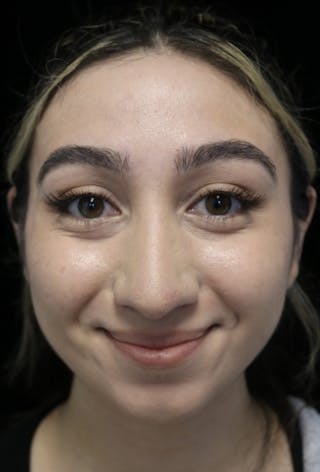 Beverly Hills Rhinoplasty Before & After Gallery - Patient 272534 - Image 6 Dr. Deepak Raj Dugar