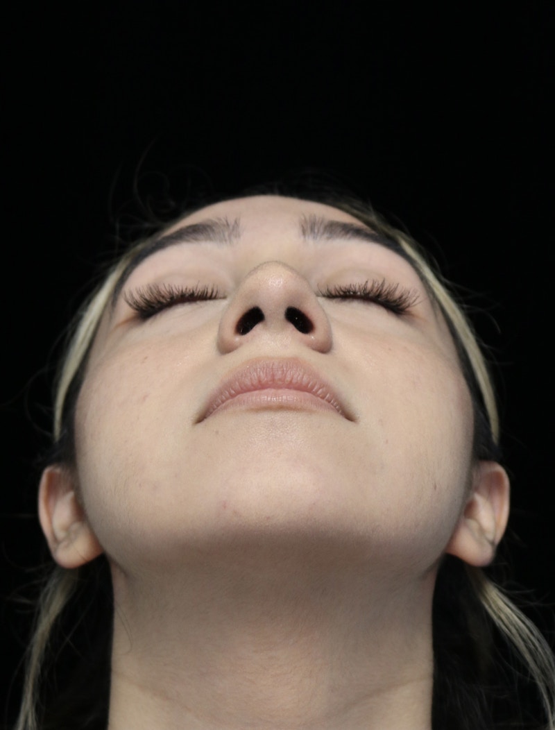 Beverly Hills Rhinoplasty Before & After Gallery - Patient 272534 - Image 8 Dr. Deepak Raj Dugar