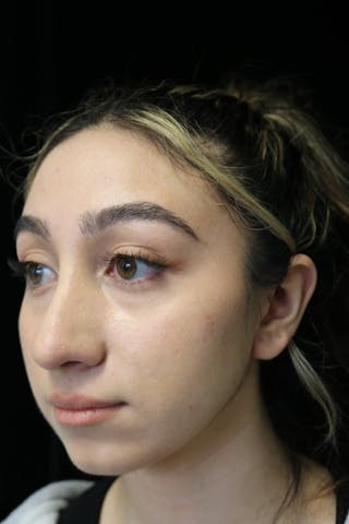 Beverly Hills Rhinoplasty Before & After Gallery - Patient 272534 - Image 10 Dr. Deepak Raj Dugar