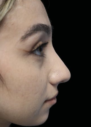 Beverly Hills Rhinoplasty Before & After Gallery - Patient 272534 - Image 2 Dr. Deepak Raj Dugar